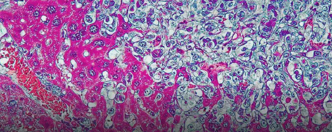 Cancerous growths in the liver of a mouse. (Credit: Imaging/tissue extraction by Anthony B. Eason; lab of Dirk Dittmer, University of North Carolina Lineberger Comprehensive Cancer Center. Mice maintained by UNC Animal Studies Core; staining by UNC Animal Histopathology Core)