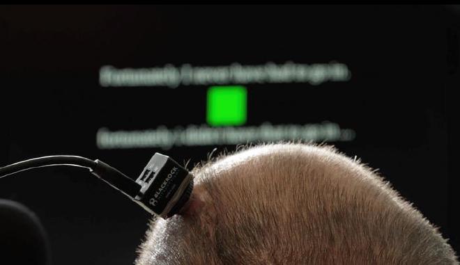 The participant is enrolled in the BrainGate2 clinical trial at UC Davis Health. His ability to communicate through a computer has been made possible with an investigational brain-computer interface (BCI). It consists of four microelectrode arrays surgically implanted into the region of the brain responsible for producing speech. These devices record the activity of neurons in the brain and send it to computers that interpret the signals to reconstruct voice. Credit: UC Davis Health