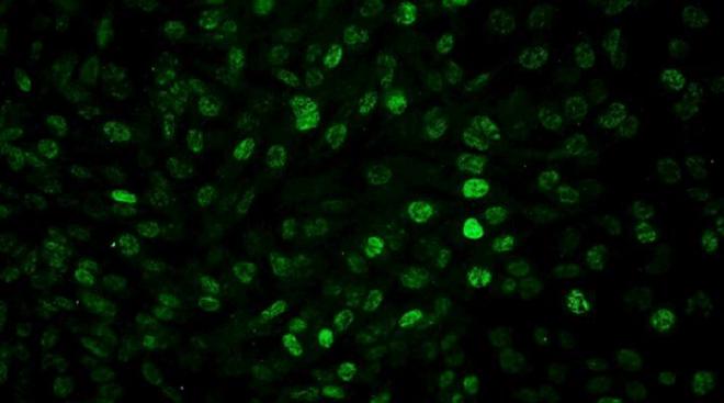 Human glioblastoma cells expressing the Foxp3 protein (green) after irradiation. Blocking this protein improved therapeutic efficacy in in vitro studies. Image credit: Marianela Candolfi et al.