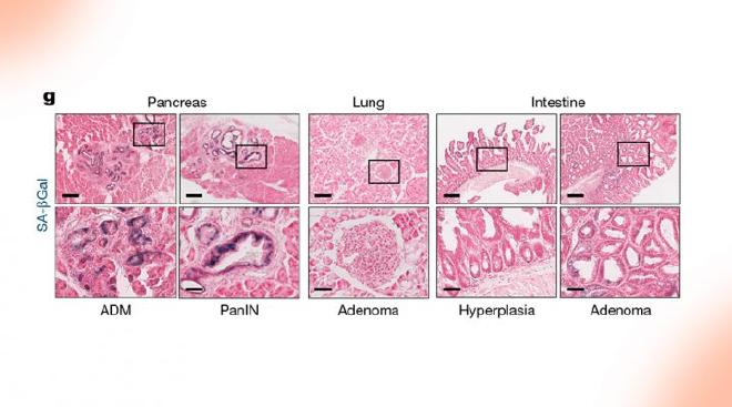 La imagen muestra cómo el oncogén KRAS impulsa la evolución del cáncer de forma distinta en cada órgano. La imagen muestra cómo el oncogén KRAS impulsa la evolución del cáncer de forma distinta en cada órgano. Crédito de la imagen: Sebastian Mueller, Roland Rad et al.