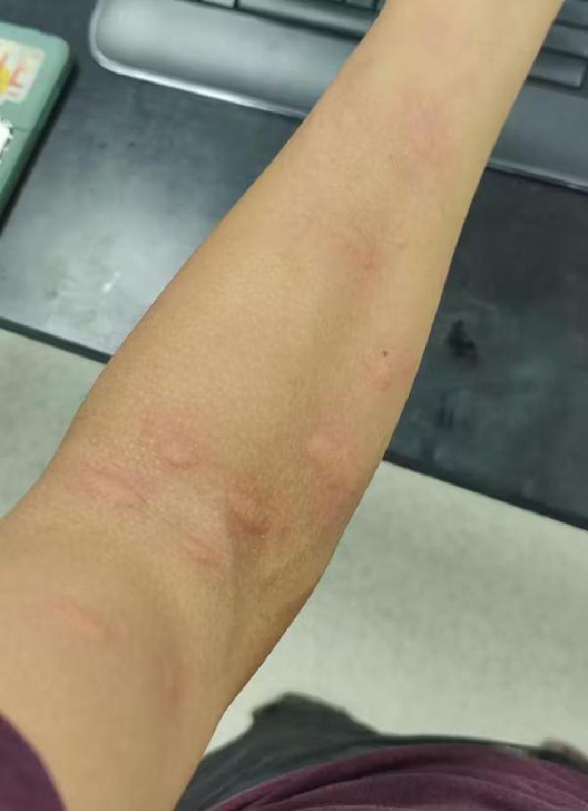 Some of Chris Zuo’s itchy results after his session with the mosquitoes. David L. Hu