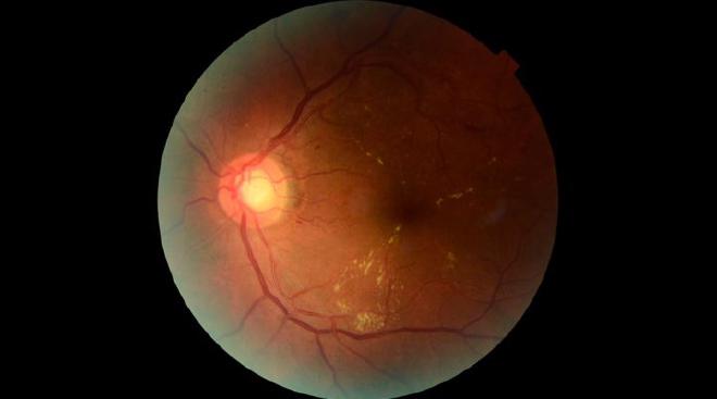 Imagen de una retina procesadas a través de Retinar. Crédito de la imagen: José Ignacio Orlando et al..