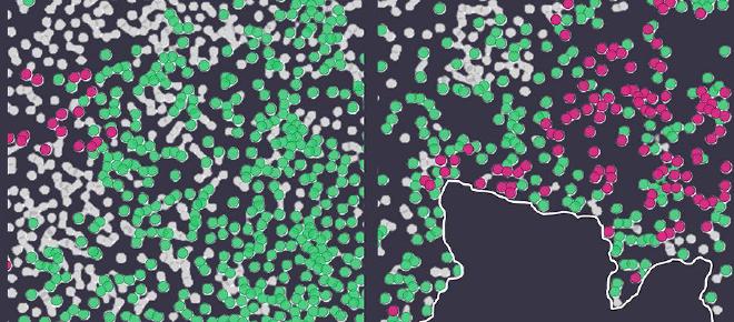 Glioblastoma murino antes (izquierda) y después de la resección quirúrgica (derecha). Las células tumorales se muestran en verde, las células TREM2-positivas susceptibles de ser tratadas con células CAR-T en magenta y todos los núcleos celulares (DAPI) en gris. Crédito y copyright de la imagen: UNIGE – Laboratorio Migliorini