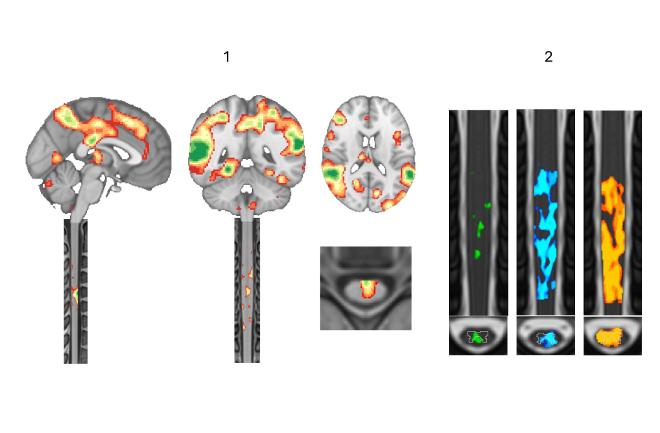 La resonancia magnética funcional ahora permite mapear la actividad más allá del cerebro. (1) Imágenes del cerebro y la médula espinal cervical en una misma exploración. (2) Respuestas de la médula espinal a pulsos magnéticos aplicados a la corteza motora con intensidad creciente, de izquierda a derecha: cuanto más fuerte es el pulso, mayor es la propagación de la actividad. Crédito de la imagen: EPFL/MIP:Lab - CC-BY-SA 4.0